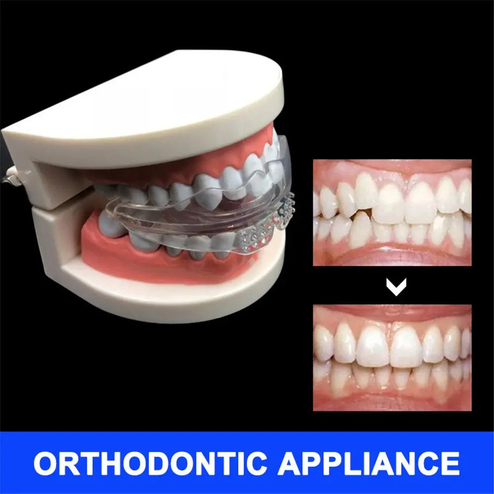 Orthodontic appliance on dental model showing teeth alignment before and after correction